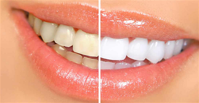 Cách lấy cao răng chỉ 2’, không cần đến nha sỹ