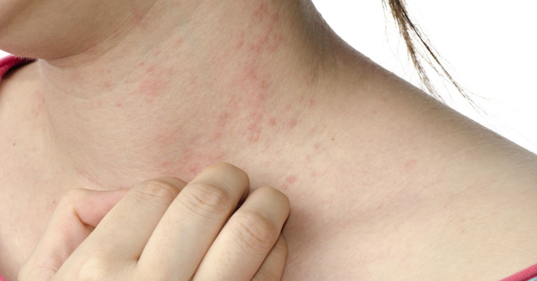 Cách xử lý khi khách hàng bị dị ứng thức ăn tại nhà hàng