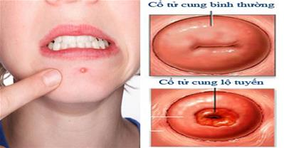 Mụn mọc quanh cằm thì 90% mắc viêm lộ tuyến cổ tử cung