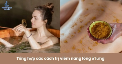 Tổng hợp các cách trị viêm nang lông ở lưng và giải pháp tối ưu nhất